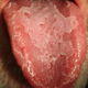 Illustration for article titled Do You Have A Geographic Tongue?